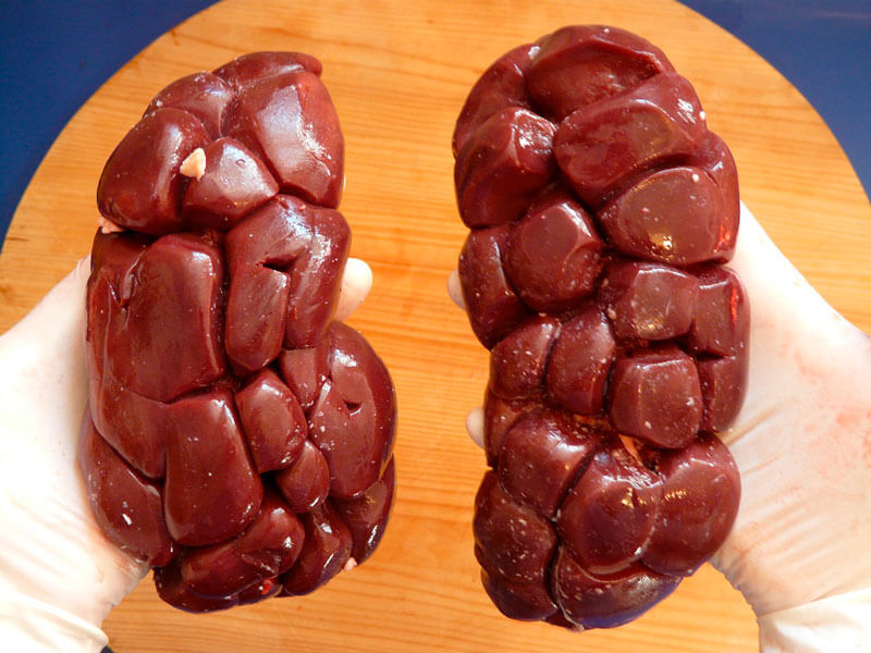 enfermedad renal